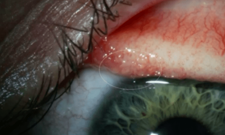 Oregon woman has 14 worms pulled from eye after rare infection