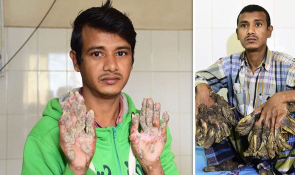 After 24 surgeries, Bangladesh 'tree man' relapses