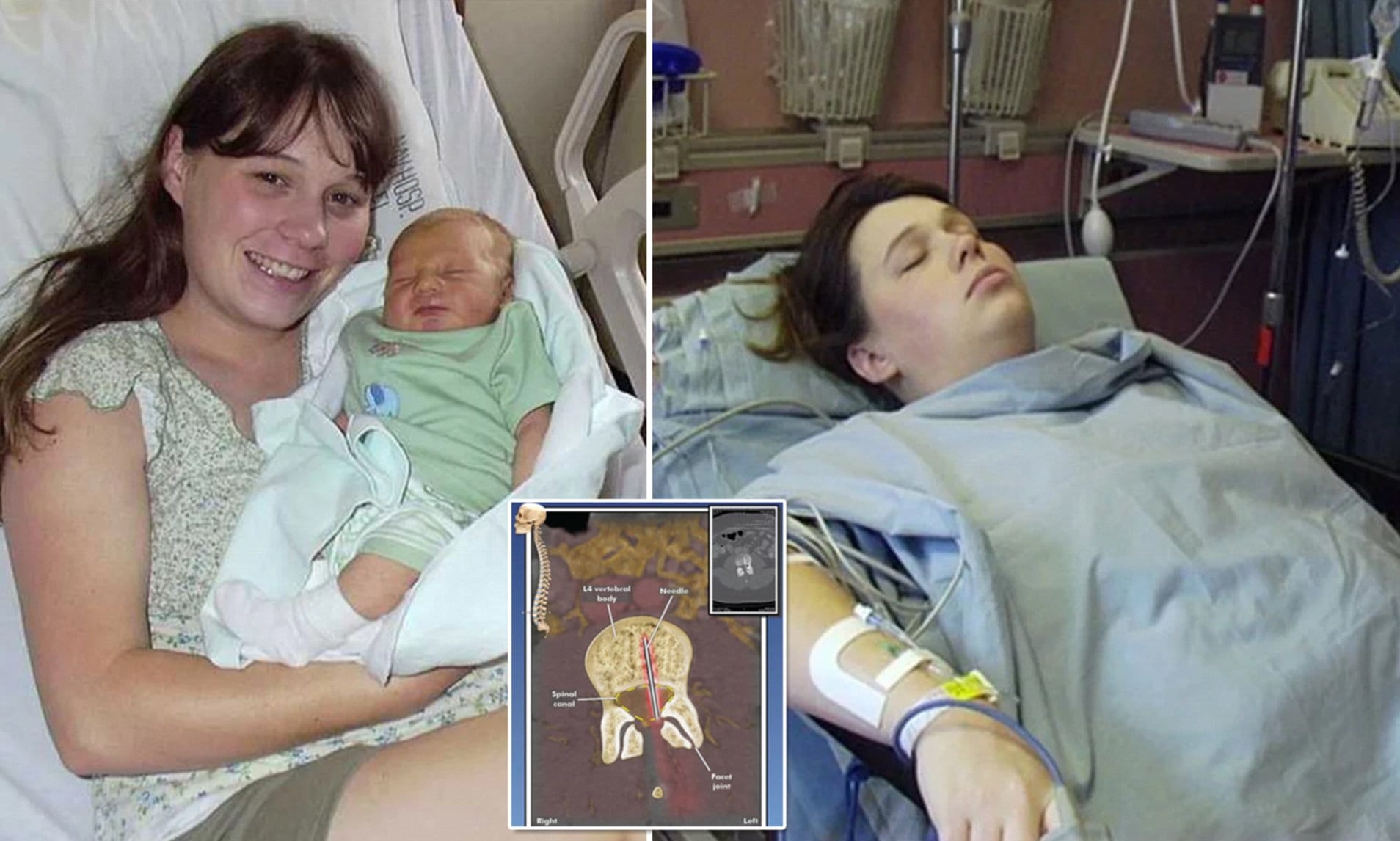 Woman Finds Epidural Needle in Her Spine 14 Years After Giving Birth: 'I'm Angry and Scared' P