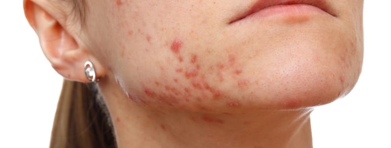 acne vulgaris