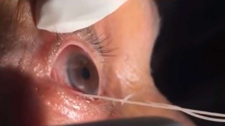 Doctor pulls out a 15 cm long worm from man's eye