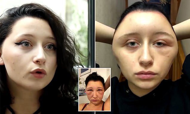 Woman's severe allergic reaction to hair dye saw her head almost DOUBLE in size
