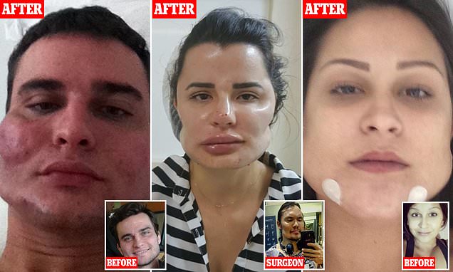 Disfigured for life by botched beauty treatments: Patients reveal their distorted features as dozens come forward to sue Brazilian plastic surgeon who carried out irreversible procedures