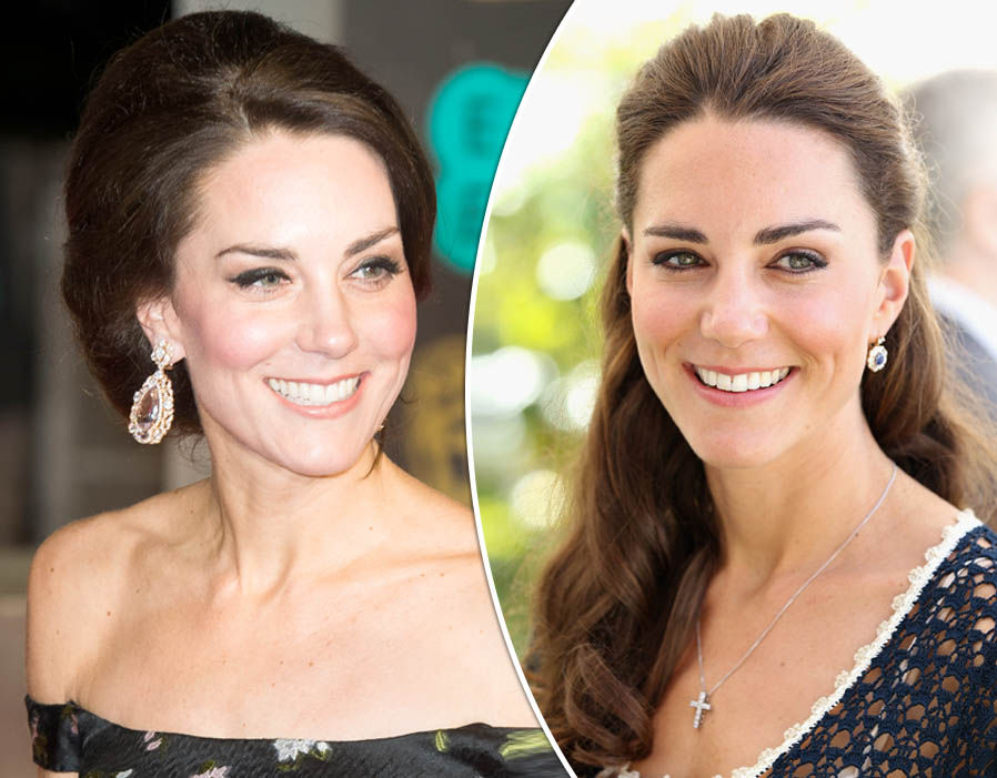 Kate Middleton Got 'Baby Botox'!