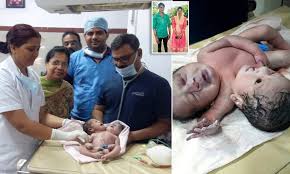 Baby with two heads and three arms is born to mother, 21, in India in 'very rare' form of conjoined twins