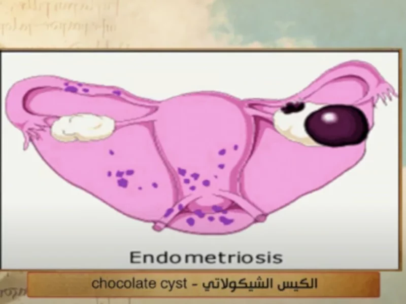 مرض أكياس الشوكولاتة